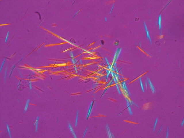 Uric Acid Crystals photo